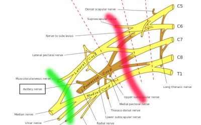 Plexus brachialis-blockader